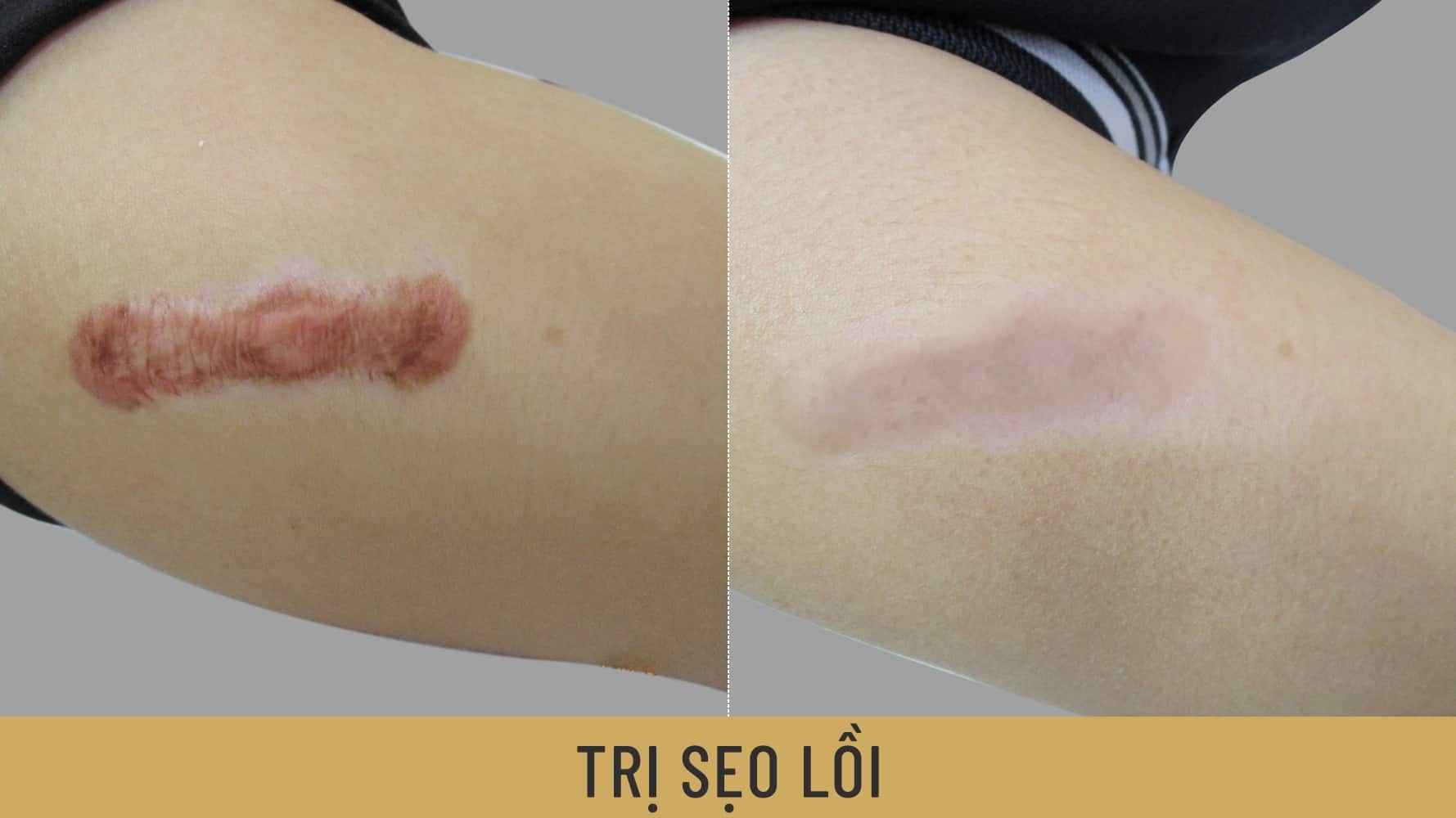 cách trị sẹo lồi