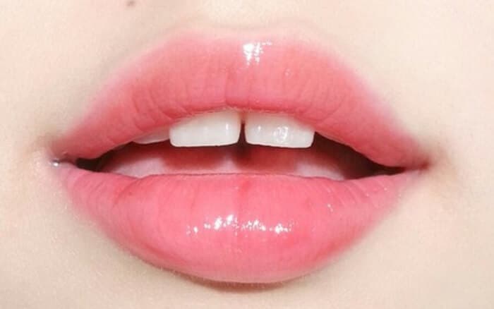 trị môi thâm bẩm sinh